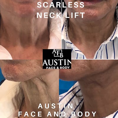 Necklift Before & After Gallery - Patient 41025539 - Image 1