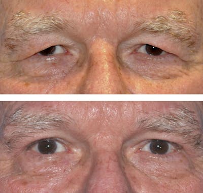 Upper Blepharoplasty Before & After Gallery - Patient 42739359 - Image 1