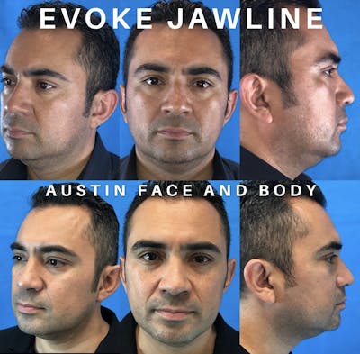 Evoke Radiofrequency Before & After Gallery - Patient 44538145 - Image 1