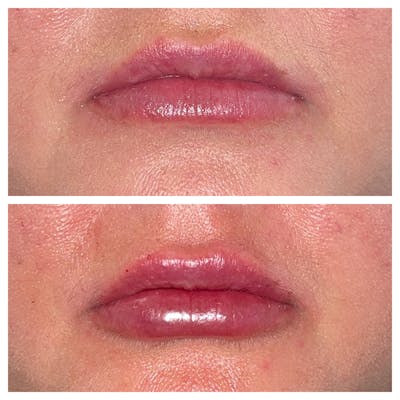 Lip Fillers Before & After Gallery - Patient 45216398 - Image 1
