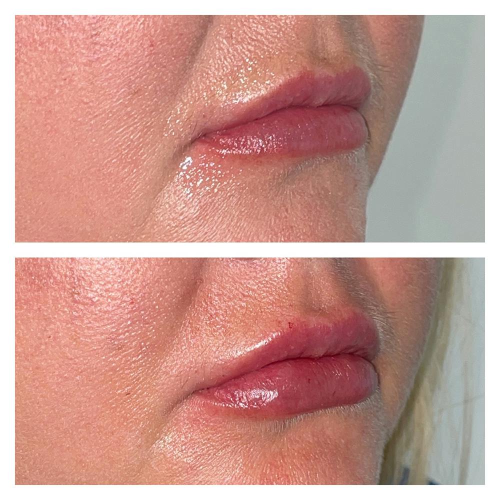 Lip Fillers Before & After Gallery - Patient 45216398 - Image 2