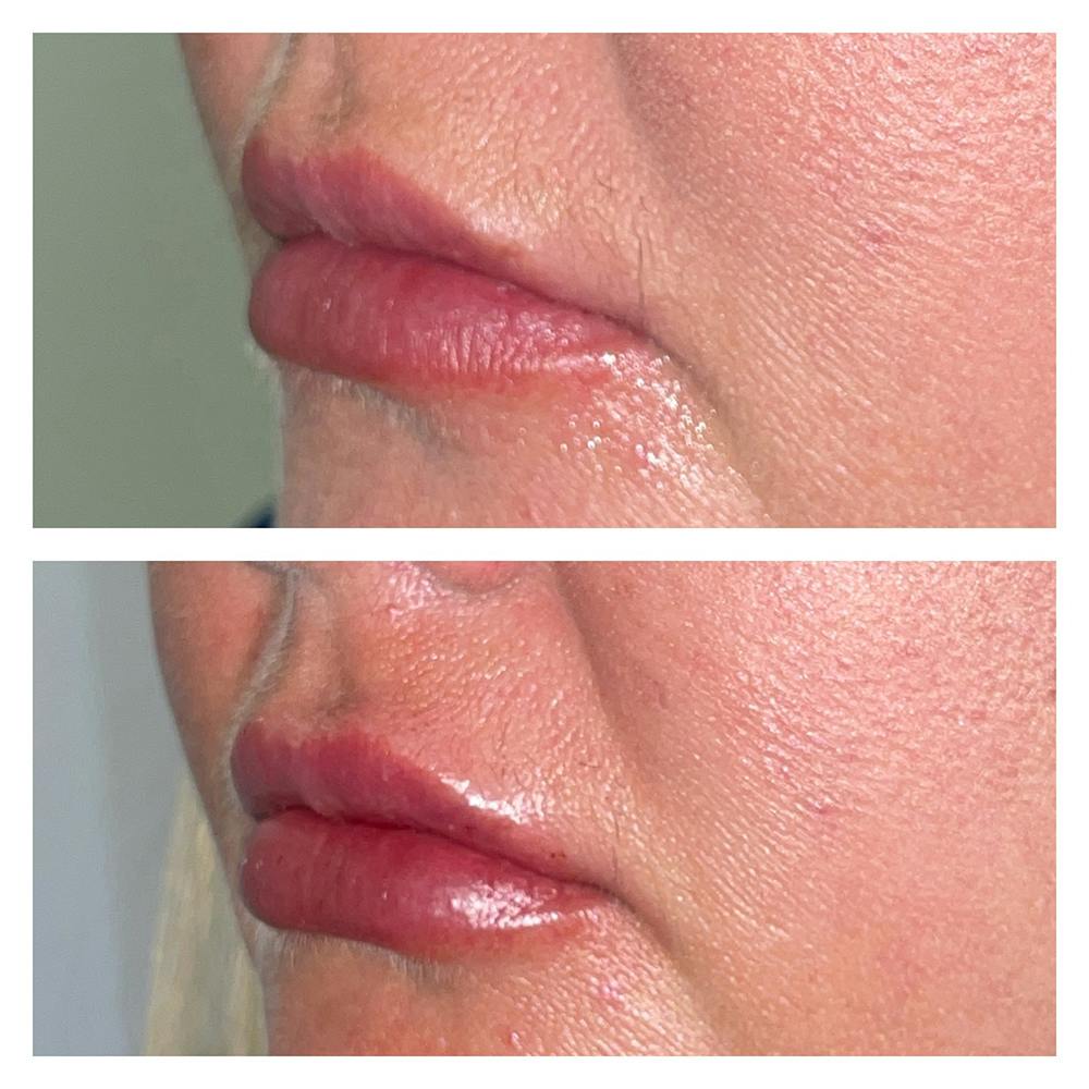 Lip Fillers Before & After Gallery - Patient 45216398 - Image 3