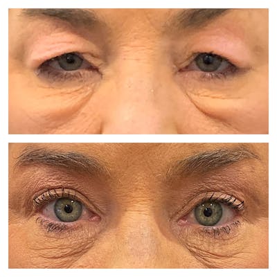 Upper Blepharoplasty Before & After Gallery - Patient 45216535 - Image 1