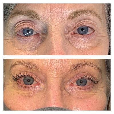 Upper Blepharoplasty Before & After Gallery - Patient 45216536 - Image 1