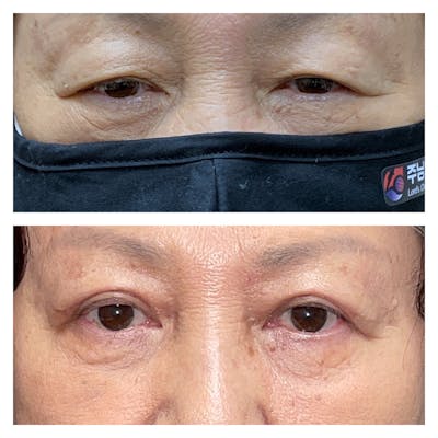 Ptosis Before & After Gallery - Patient 45216538 - Image 1