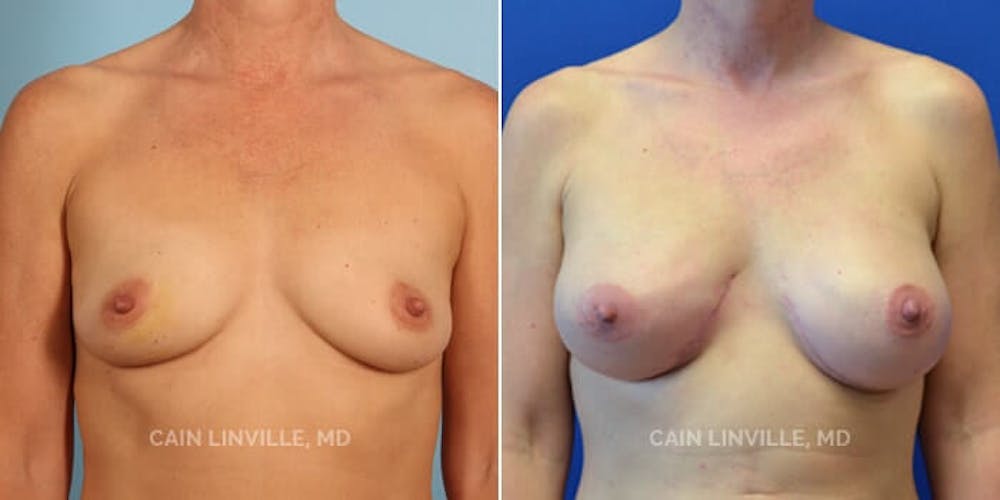 Breast Reconstruction  Before & After Gallery - Patient 48689414 - Image 1