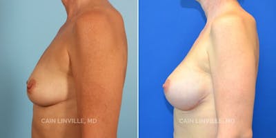 Breast Reconstruction  Before & After Gallery - Patient 48689414 - Image 2