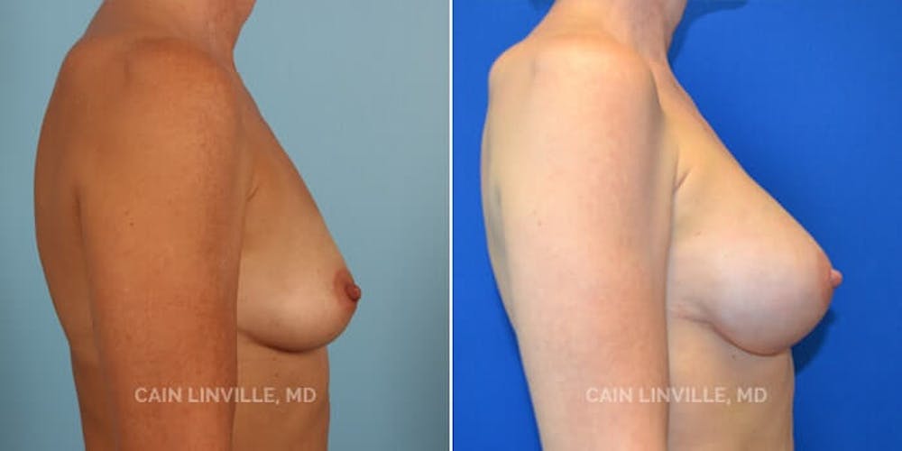 Breast Reconstruction  Before & After Gallery - Patient 48689414 - Image 3