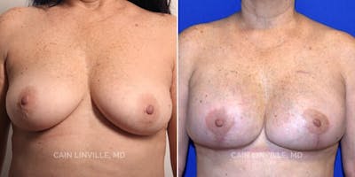 Breast Reconstruction  Before & After Gallery - Patient 48689430 - Image 1