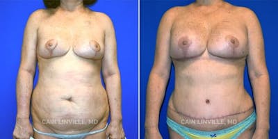 Breast Reconstruction  Before & After Gallery - Patient 48689430 - Image 2