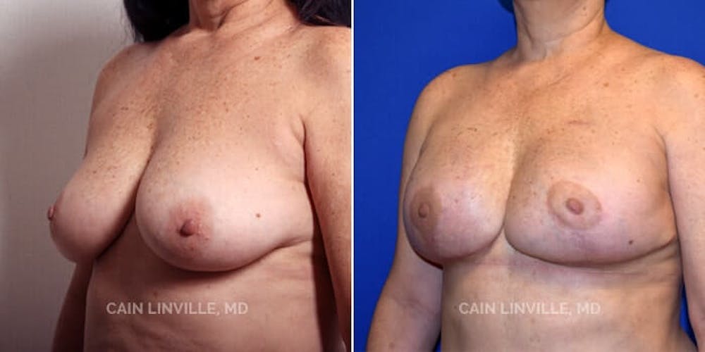 Breast Reconstruction  Before & After Gallery - Patient 48689430 - Image 3
