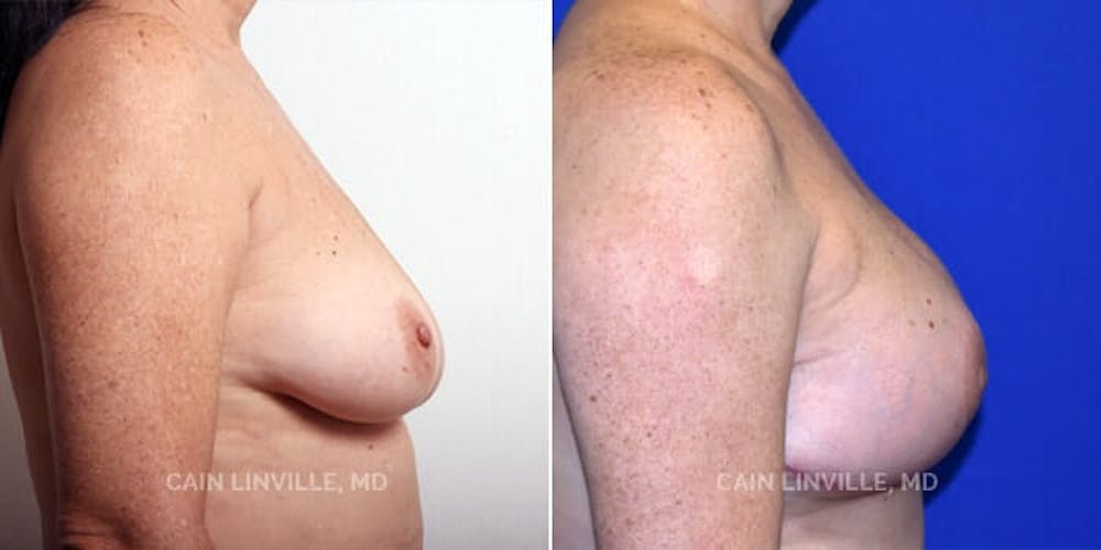 Breast Reconstruction  Before & After Gallery - Patient 48689430 - Image 5