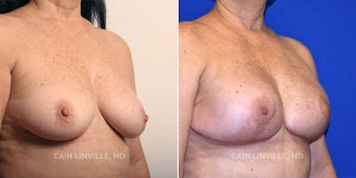 Breast Reconstruction  Before & After Gallery - Patient 48689430 - Image 6