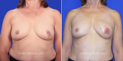 Breast Reconstruction  Before & After Gallery - Patient 48689441 - Image 1