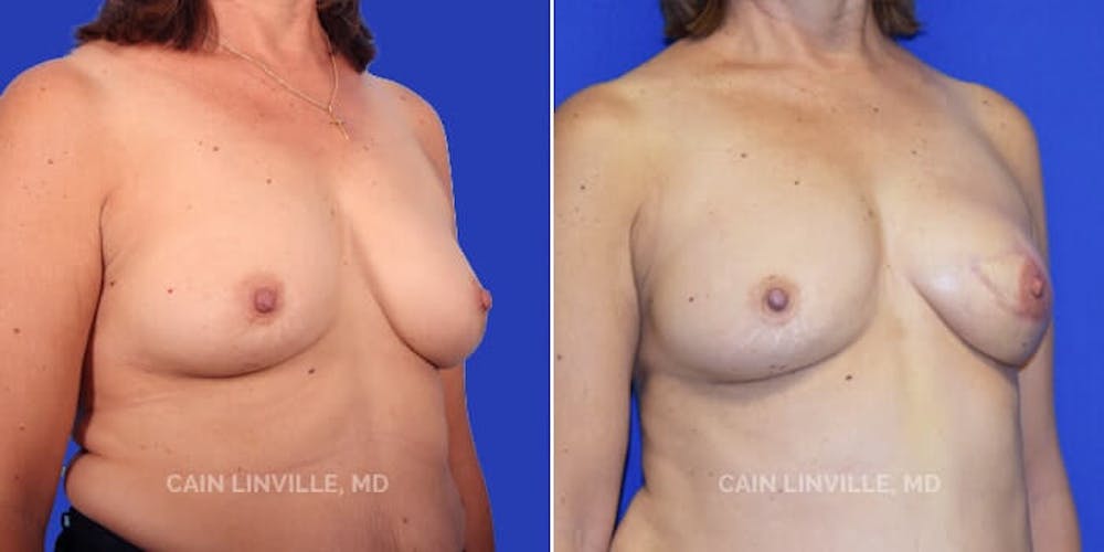 Breast Reconstruction  Before & After Gallery - Patient 48689441 - Image 2