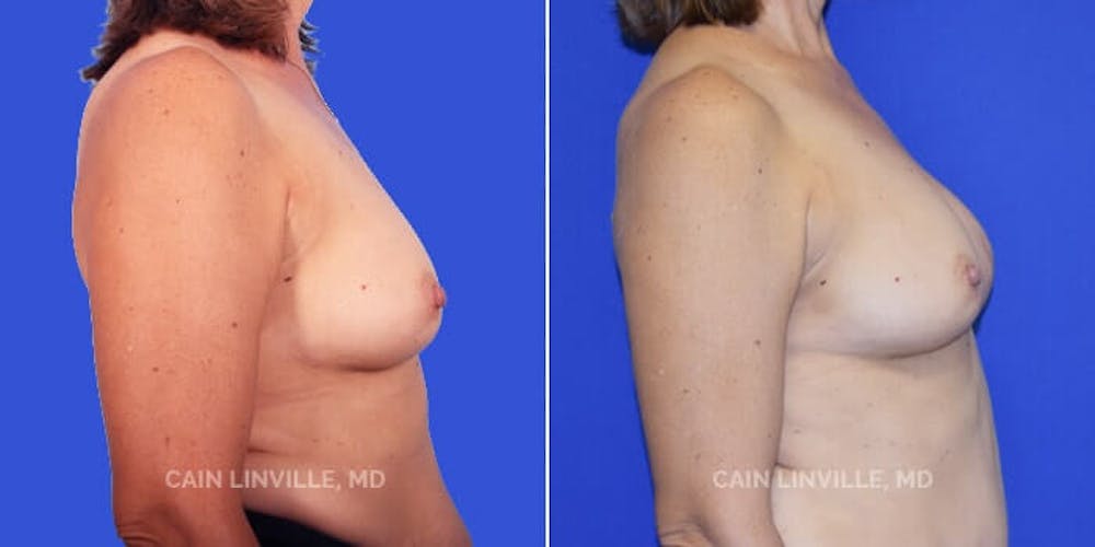 Breast Reconstruction  Before & After Gallery - Patient 48689441 - Image 3