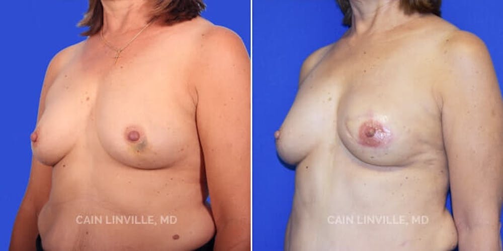 Breast Reconstruction  Before & After Gallery - Patient 48689441 - Image 4