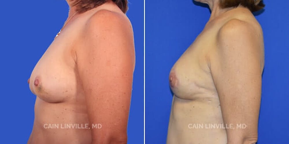 Breast Reconstruction  Before & After Gallery - Patient 48689441 - Image 5