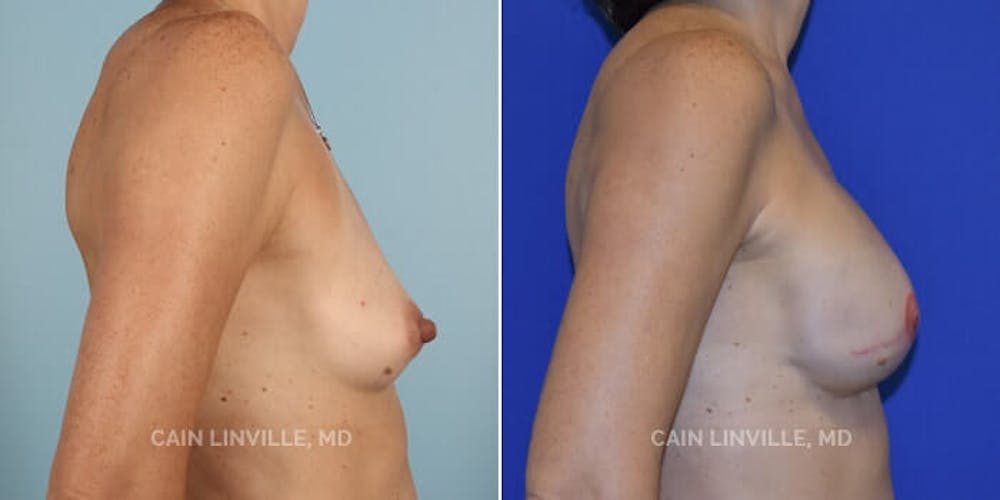 Breast Reconstruction  Before & After Gallery - Patient 48689463 - Image 3