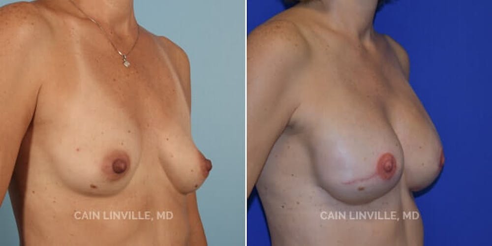 Breast Reconstruction  Before & After Gallery - Patient 48689463 - Image 2