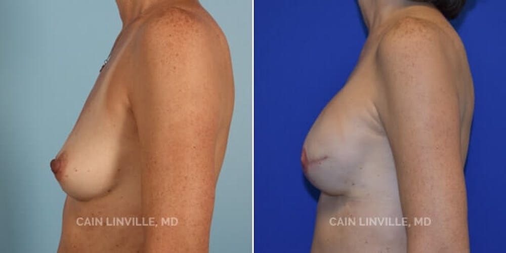 Breast Reconstruction  Before & After Gallery - Patient 48689463 - Image 4