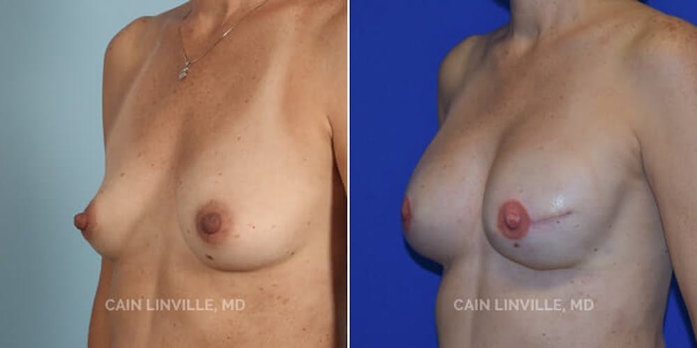 Breast Reconstruction  Before & After Gallery - Patient 48689463 - Image 5