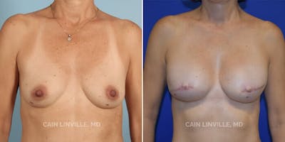 Breast Reconstruction  Before & After Gallery - Patient 48689463 - Image 1