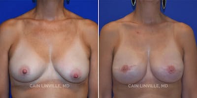 Breast Reconstruction  Before & After Gallery - Patient 48689472 - Image 1