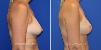 Breast Reconstruction  Before & After Gallery - Patient 48689472 - Image 2