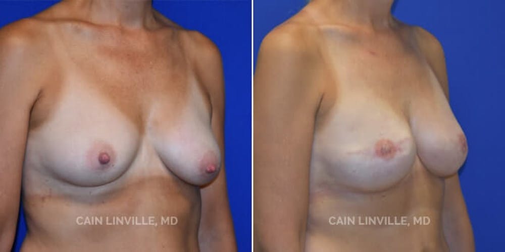 Breast Reconstruction  Before & After Gallery - Patient 48689472 - Image 3