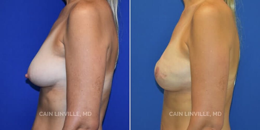 Breast Reconstruction  Before & After Gallery - Patient 48689472 - Image 4