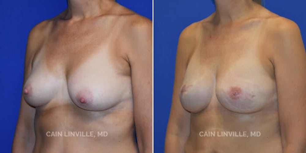 Breast Reconstruction  Before & After Gallery - Patient 48689472 - Image 5