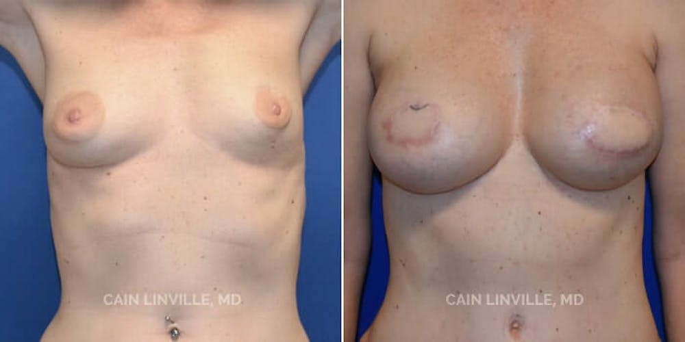 Breast Reconstruction  Before & After Gallery - Patient 48689473 - Image 1