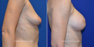 Breast Reconstruction  Before & After Gallery - Patient 48689473 - Image 2