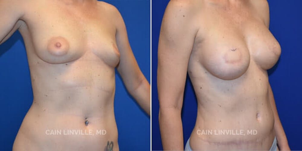 Breast Reconstruction  Before & After Gallery - Patient 48689473 - Image 3