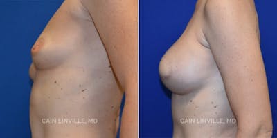 Breast Reconstruction  Before & After Gallery - Patient 48689473 - Image 4
