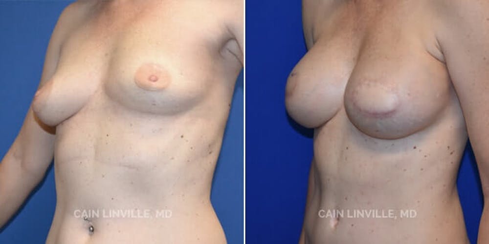 Breast Reconstruction  Before & After Gallery - Patient 48689473 - Image 5