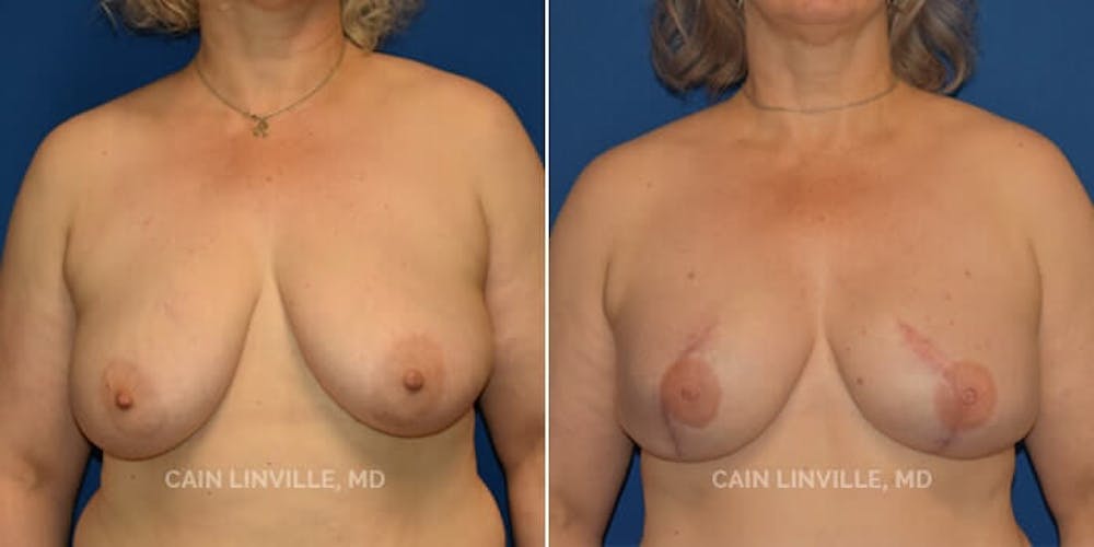 Breast Reconstruction  Before & After Gallery - Patient 48689482 - Image 1