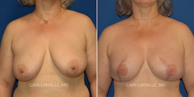 Breast Reconstruction  Before & After Gallery - Patient 48689482 - Image 1