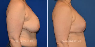 Breast Reconstruction  Before & After Gallery - Patient 48689482 - Image 2