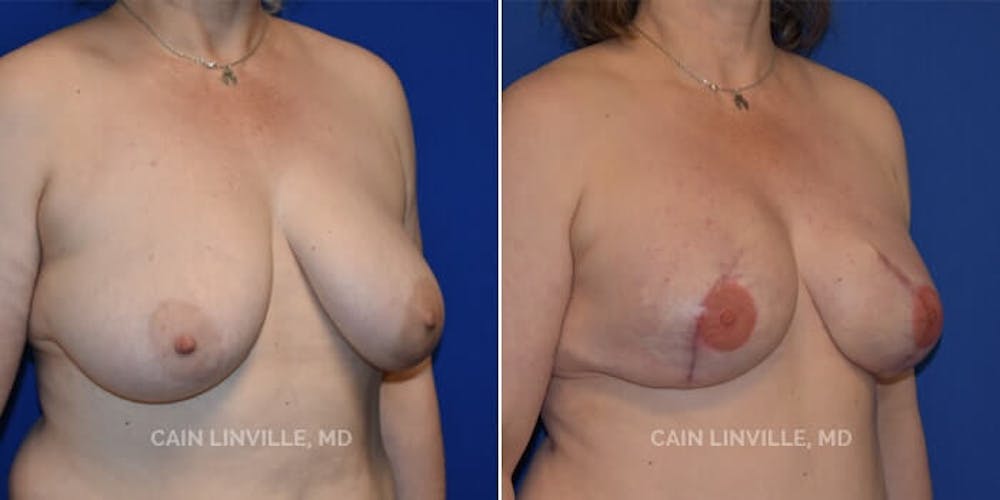 Breast Reconstruction  Before & After Gallery - Patient 48689482 - Image 3
