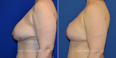 Breast Reconstruction  Before & After Gallery - Patient 48689482 - Image 4