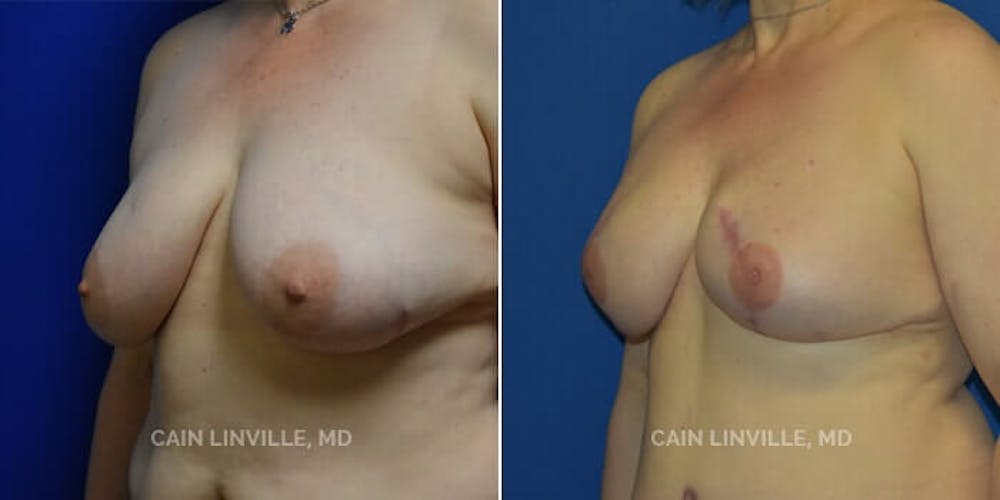 Breast Reconstruction  Before & After Gallery - Patient 48689482 - Image 5