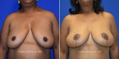 Breast Reconstruction  Gallery - Patient 48689534 - Image 1