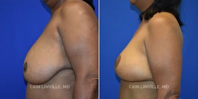 Breast Reconstruction  Before & After Gallery - Patient 48689534 - Image 2