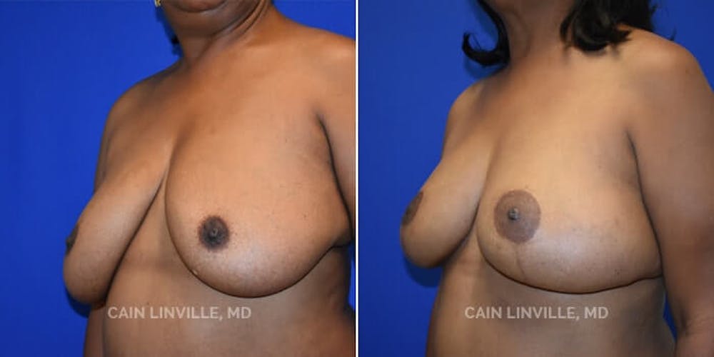 Breast Reconstruction  Before & After Gallery - Patient 48689534 - Image 3