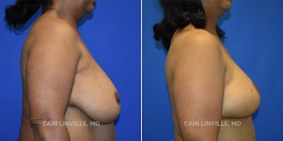 Breast Reconstruction  Before & After Gallery - Patient 48689534 - Image 4