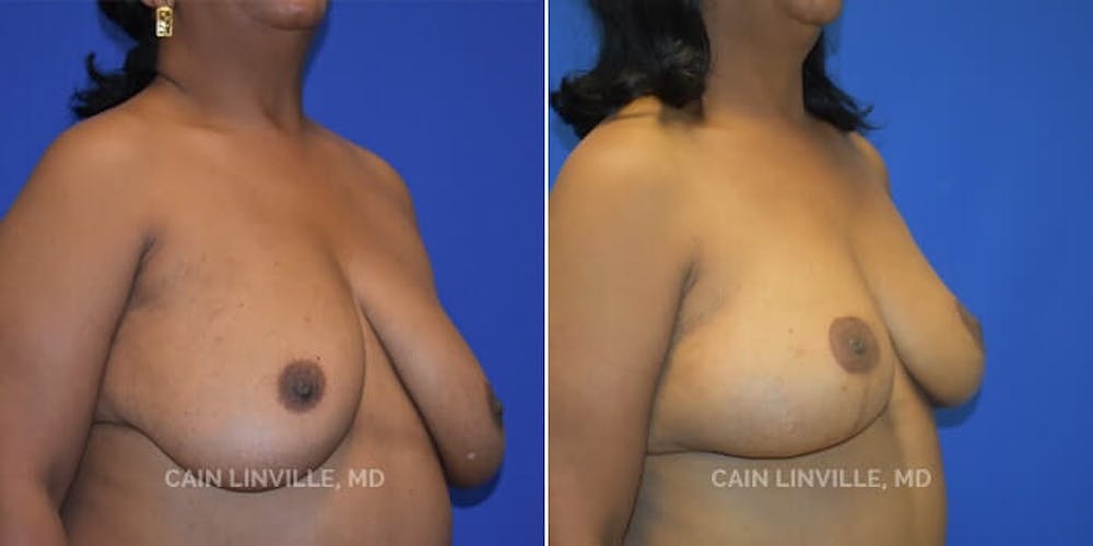 Breast Reconstruction  Before & After Gallery - Patient 48689534 - Image 5