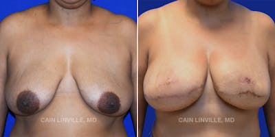 Breast Reconstruction  Before & After Gallery - Patient 48689535 - Image 1