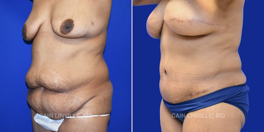 Breast Reconstruction  Before & After Gallery - Patient 48689535 - Image 3